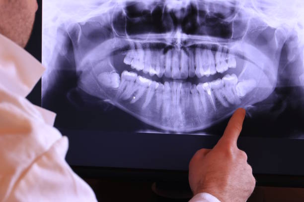 Best Emergency Tooth Extraction in Clearwater, SC