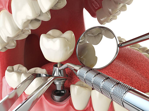 Best Emergency Root Canal Treatment in Clearwater, SC